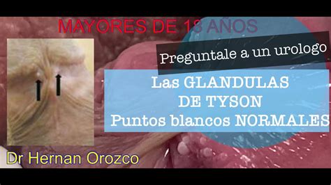 ¿Por qué salen las glándulas de Tyson o bolitas。